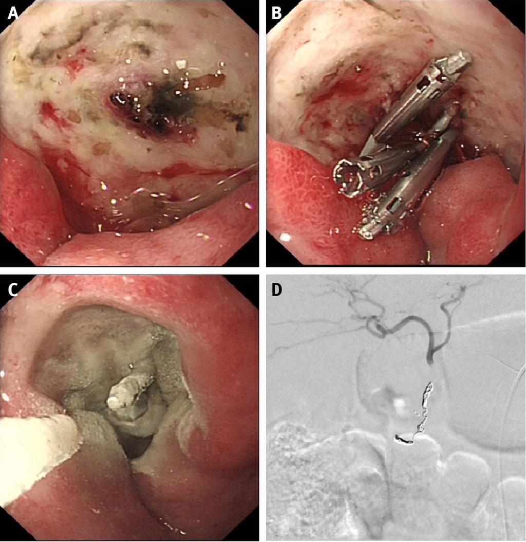 Fig 4 (A) Endoscopic view of a large posterior duodenal ulcer with intermittent bleeding from a visible vessel.