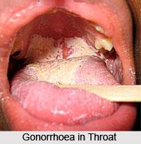 Gonorrhoea in pre-pubertal children Gonorrhoea outside the neonatal period is strongly suggestive of CSA ( virtually 100% CDC guidelines 2015) Period of latency of congenital eye infection.