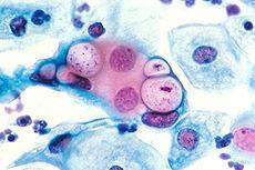 Chlamydia Commonest reported STD in USA (> under 24yrs) - PID, ectopic pregnancy, infertility Chlamydia infection outside neonatal period strongly suggestive of CSA 75-94% of under 12 s Perinatally