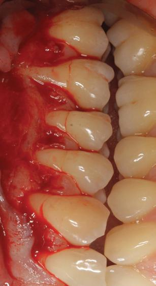 The Approach My Treatment goals included completing root coverage of the recession defects and augmentation of the width of attached keratinized tissue by tooth #14.