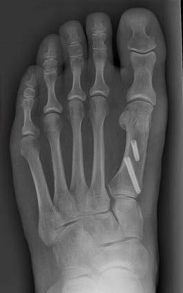tissues and cuts in the bone (osteotomy) to correctly align the 1 st metatarsal