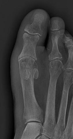 Hardware, such as screws or pins may be used to stabilize the osteotomy.