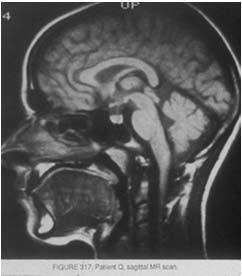 Pituitary Adenomas: Epidemiology Pituitary Adenoma Pituitary adenomas are the 3 rd most common brain tumor. They account for 10-15% of all intracranial tumors. MRI studies 14.4% Autopsy series 12-22.