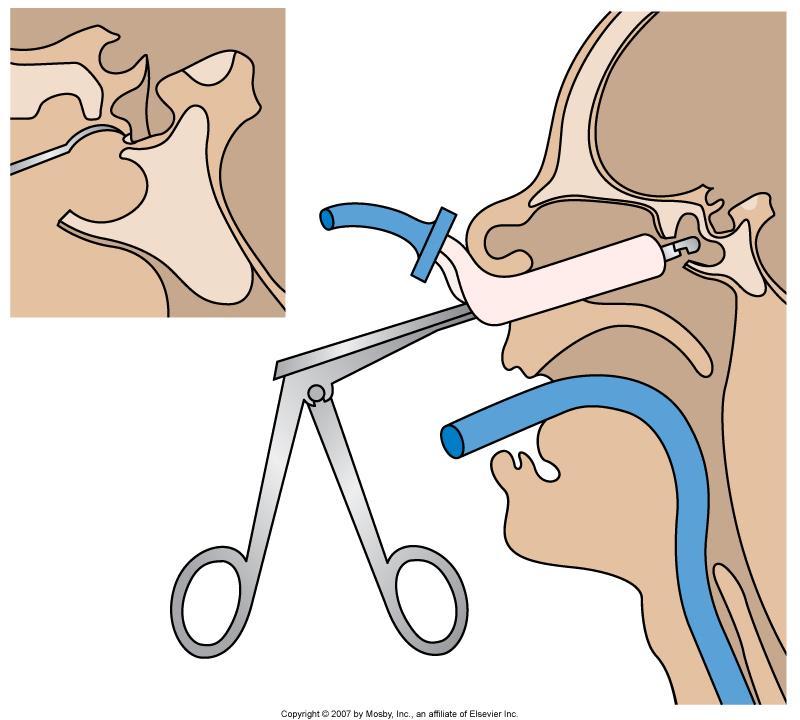 Neurosurgery: Transsphenoidal hypophysectomy Most commonly