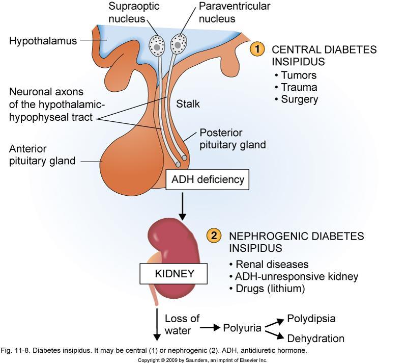 Posterior Hypopituitary-ADH disorders Diabetes Insipidus-(DI) (too little ADH) Etiology: (50% idiopathic)