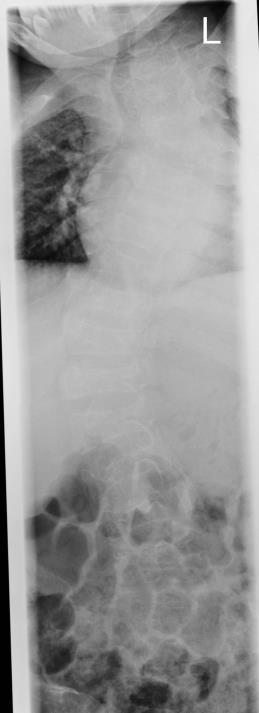 Scoliosis Scoliosis occurs in 40-52% of patients Important to monitor for