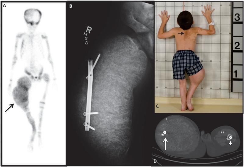 Denosumab & Fibrous Dysplasia 9 yr old boy with MAS Required amputation of Rt Femur Failure of response to