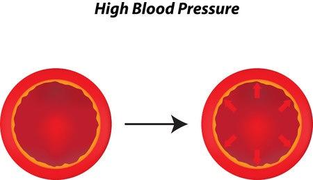 Hypertension, also referred to as high blood pressure or HTN, is a medical condition in which the blood pressure is chronically elevated. It is a very common illness.