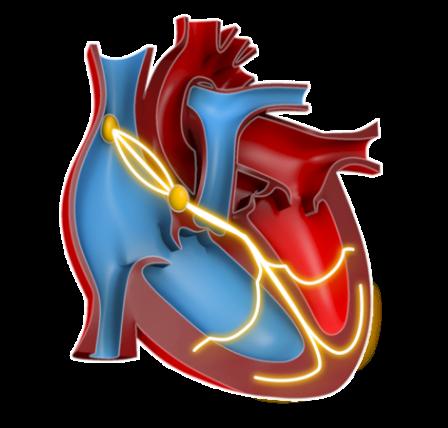 Atrial remodelling consists of 3 key components u Electrical remodelling Shortening of