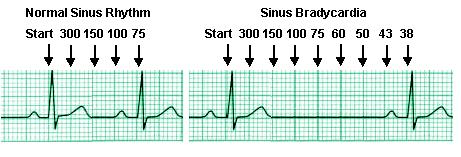 McHenry Western Lake County EMS System Optional CE for EMT-B, Paramedics and PHRN s Bradycardia and Treatments Optional #7 2018 This month we will be looking at a specific ECG Rhythm and its
