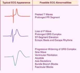 EKG Progression of Hyperkalemia Mild (5.5-6.
