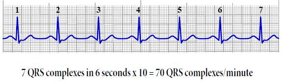 Analyzing a Rhythm Strip Heart Rate Methods of calculation 1. Six second count Barill, T. (2012).