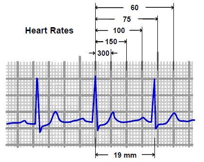 Analyzing a Rhythm Strip Heart Rate Methods of calculation 2. Countdown Method Barill, T. (2012).