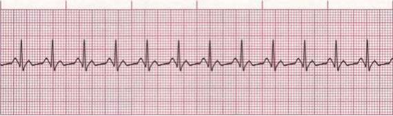 Sinus Tachycardia Rate: Greater than 100bpm P wave for every QRS Rhythm: