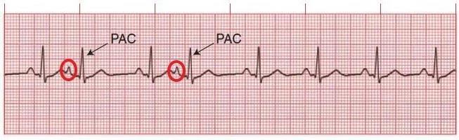 Atrial Arrhythmias Premature Atrial Contraction (PAC) Conducted (QRS complex following) or