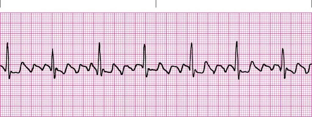 Atrial Flutter Atrial rate approx.
