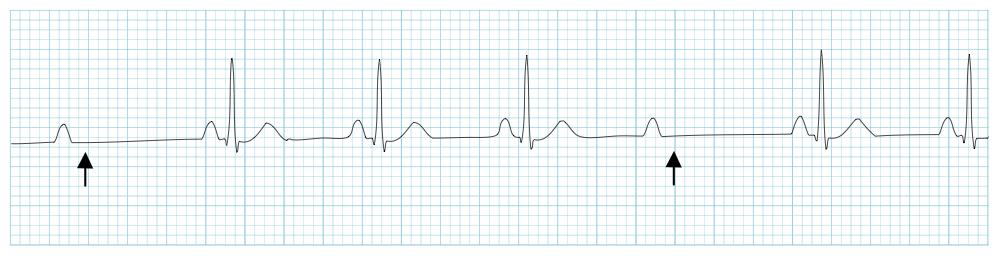 2 nd Degree AV Block Type II *AKA Mobitz II* Rate: Normal (A>V) P wave for every QRS