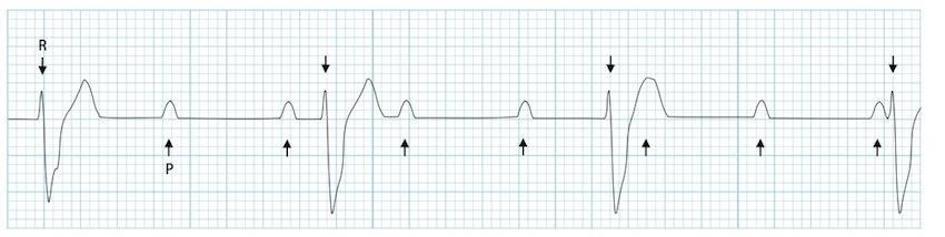 3 rd Degree AV Block (Complete) *Potential LIFE THREATENING Rhythm* Rate: Slow (20-60) QRS: normal or wide