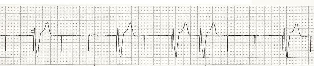 Pacemaker Troubleshooting Failure to Capture