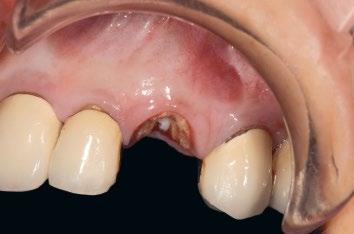 238 Fig 4 In cses where n dhesive provisionl restortion ws not possile (), n crylic removle prtil