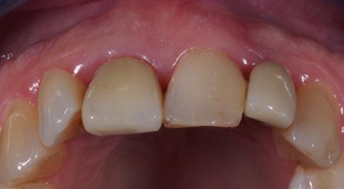 3 Below is a clinical case of coronal fracture of tooth 11 with periapical lesion showing