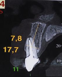 immediate implant positioning Following clinical, radiographic and tomographic