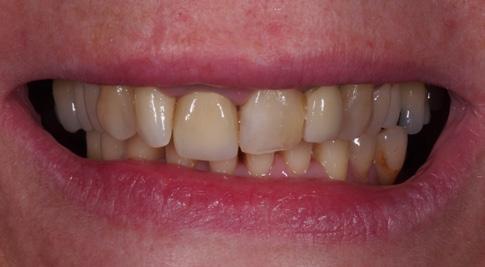 and immediate esthetic loading in order to be able to control and compensate for bone and