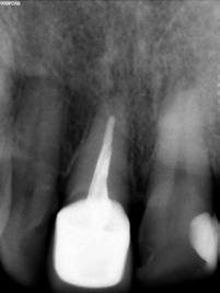 1 Initial orthopantomograph of patient Prior panoramic X-ray of tooth 11 Orthoradial