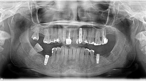 bone that can provide primary stability to our implant Extraoral photograph showing a