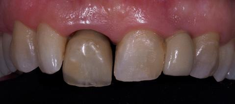 4 Tooth 11 was extracted and an AVINENT Implant System Biomimetic Ocean (3.