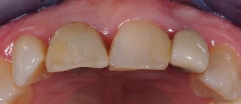 made of resin that provided correct 3D positioning of the tooth to be restored