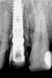 Post-surgery panoramic X-ray of Ocean implant with provisional crown