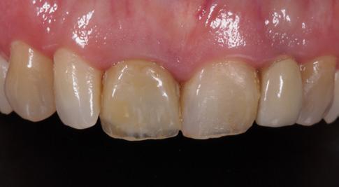 gingival levels Occlusal intraoral photograph of provisional crown at 4 months