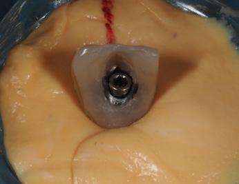 5 Insertion torque was 45 Ncm, the implant holder was removed and the implant was grinded to be able to