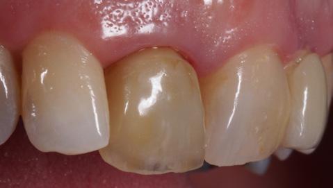 opaque so that the provisional crown could be left for a total of 4 months, thereby adequately handling