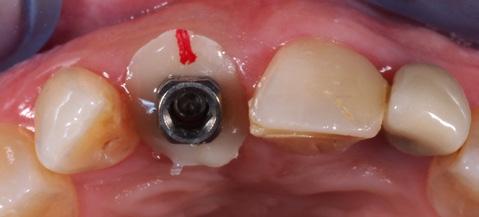 screwed to the implant was created using CAD-CAM