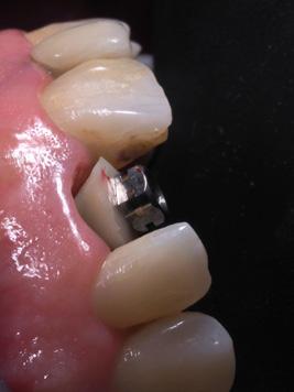 implant holder Insertion of personalized transfer