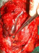 World Articles of Ear, Nose and Throat ---------------------Page 2 excision was done with pathologically confirmed clear margins. However, a prophylactic cervical nodal dissection was not carried out.