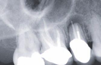 Fortynine patients received one implant and 14 patients received two implants. All of the 2-implant placements were splinted. The mean implant stability quotient (ISQ) at the time of placement was 80.