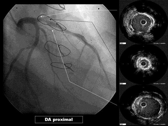 Be careful when implanting stents without pre-dilatation!