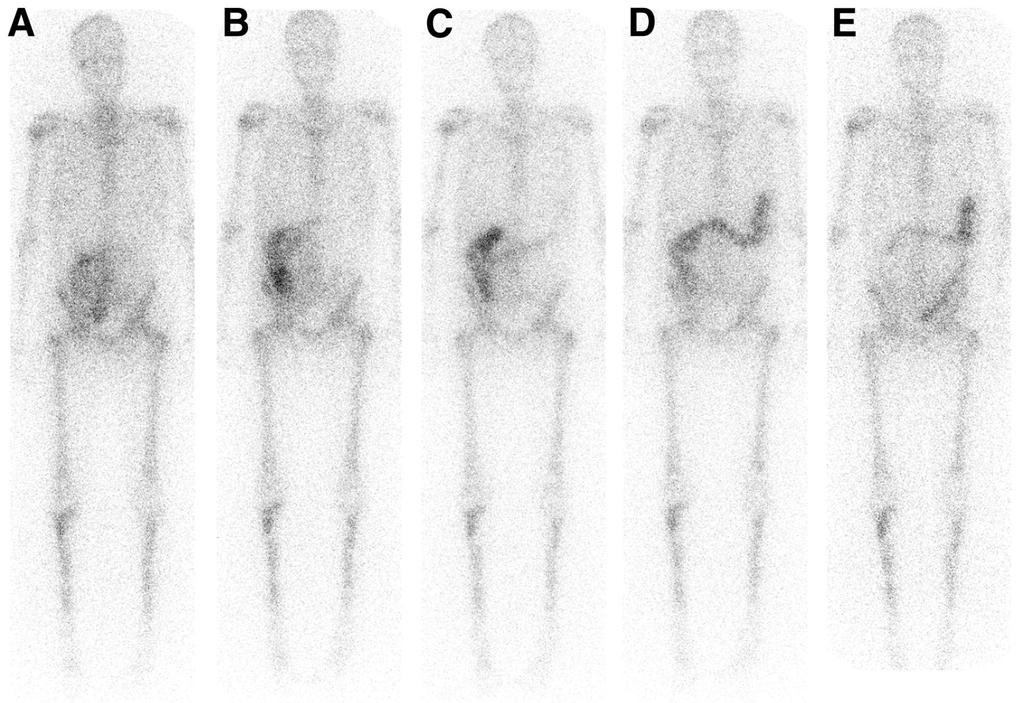 Whole-body anterior images for patient 3 acquired at 4 (A), 24 (B), 48 (C), 72 (D), and 144 h (E) after