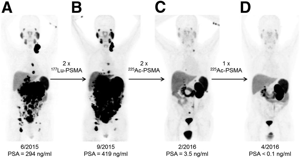 225 Ac-PSMA-617 Therapy for Prostate Cancer ( 68 Ga-PSMA-11 PET) 68Ga-PSMA-11 PET/CT scans of patient B.