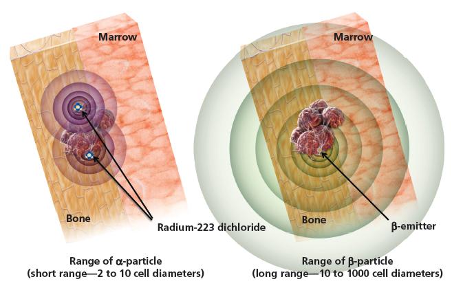 Comparison of Radium-223 and Beta-Emitting Radioactive Therapeutic Agents Note: image portrays relative ranges of alpha- and beta-particles, which are not drawn to scale.