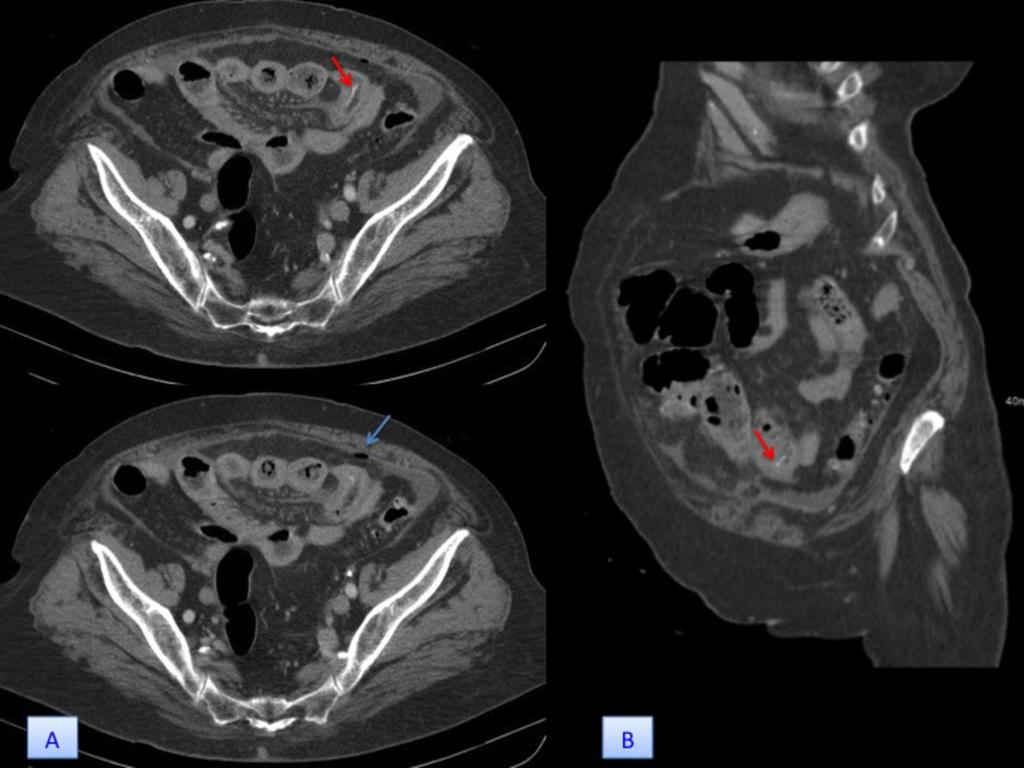 Fig. 2: 83-year-old woman (patient 2) with jejunum perforation.