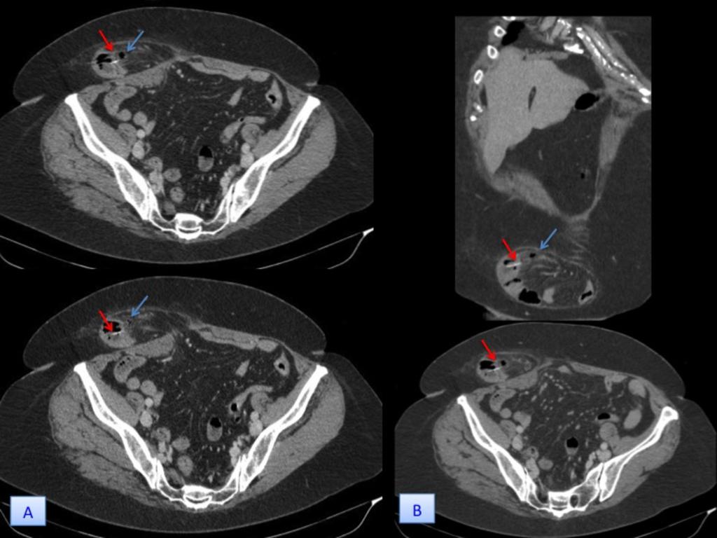 Fig. 3: 61-year-old woman (patient 3) with ileum perforation into a ventral hernia.