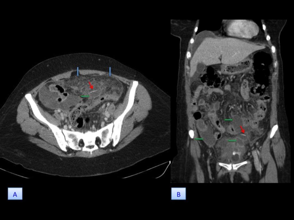 Fig. 4: 48-year-old woman (patient 4) with sigmoid colon perforation.