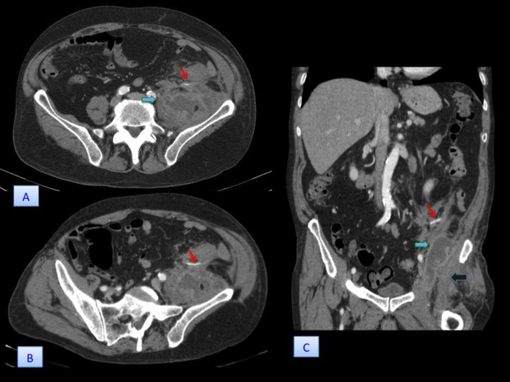 Fig. 5: 65-year-old man (patient 5) with sigmoid colon perforation.