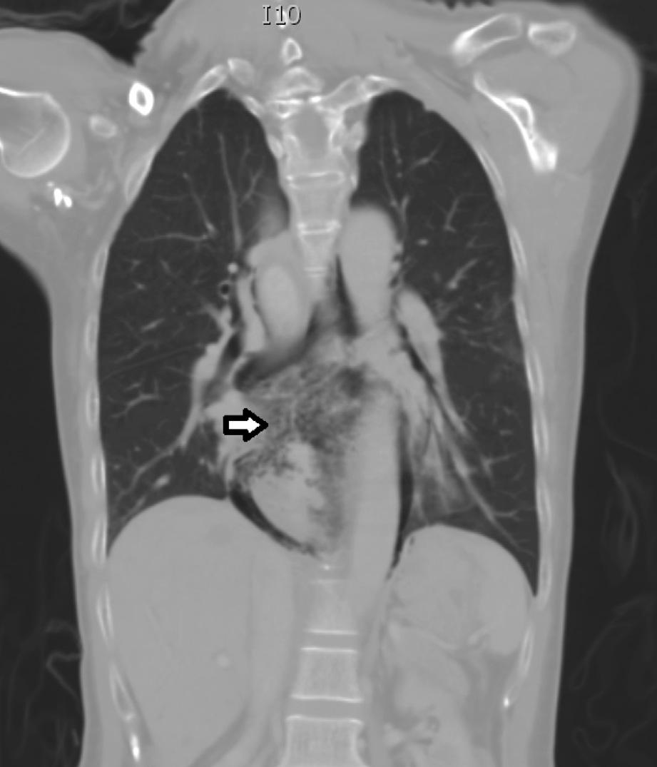 8 Perforations at the gastroesophageal junction can manifest as acute abdominal pain, with signs of peritonitis and rarely gastrointestinal bleeding.