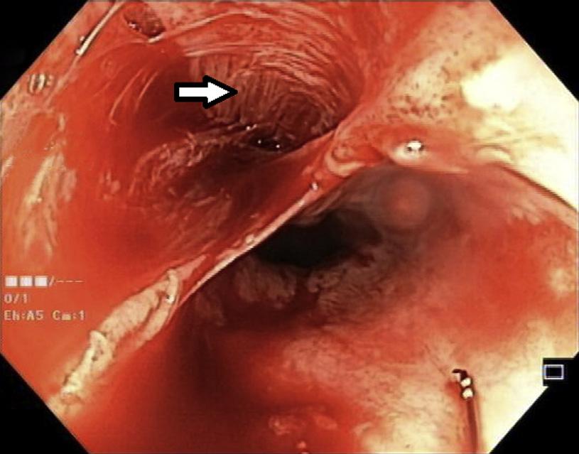 Ronald V. Romero and Khean-Lee Goh / Treatment of esophageal perforation 3 Fig. 4. Endoscopic view of esophageal perforation after stricture dilatation, showing the adventitia layer (arrow). Fig. 5.