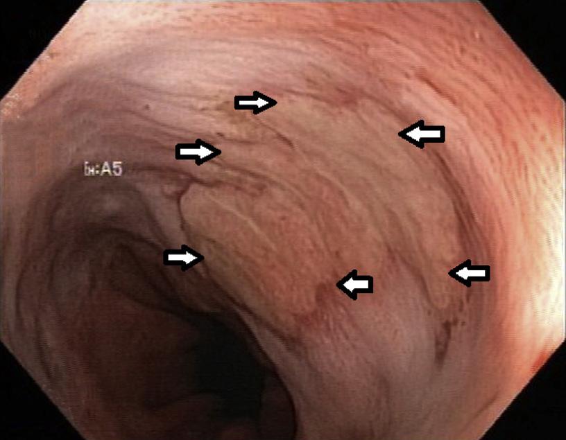 4 Gastrointestinal Intervention 2013 2(1), 1 6 Fig. 6. Stent removal after 6 weeks, showing re-epithelialization and closure of defect (arrows).